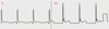 ECG anormal mostrando ondas J (V4) (Osborn)