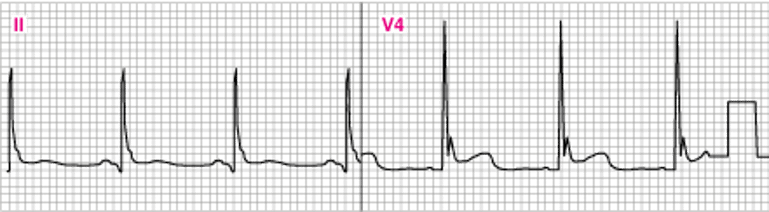 ECG anormal mostrando ondas J (V4) (Osborn)