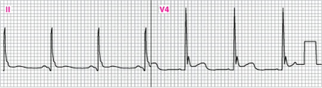Изменения на ЭКГ, показывающие зубцы J (зубцы Осборна) (V4)