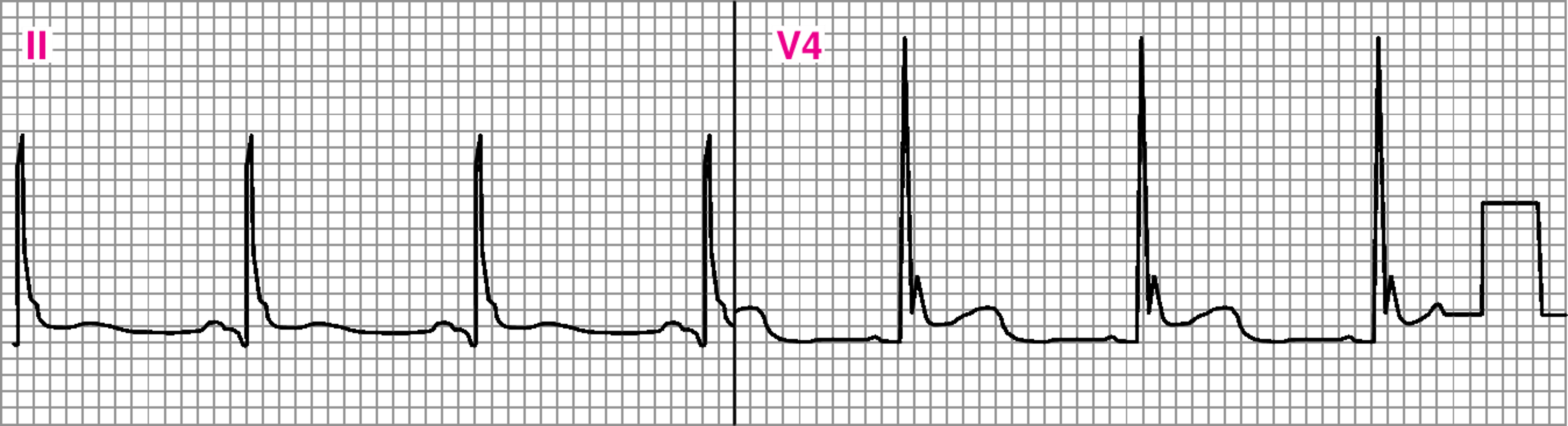 ECG bất thường hiển thị sóng J (Osborn) bất thường (V4).