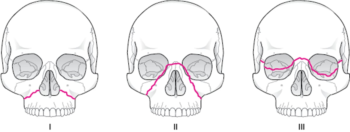 Clasificación de Le Fort para fracturas del macizo medio facial