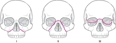 Clasificación de Le Fort para fracturas del macizo medio facial