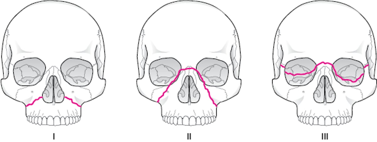 Classification des fractures faciales selon Le Fort