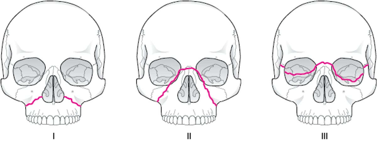 中顔面骨折のLe Fort分類