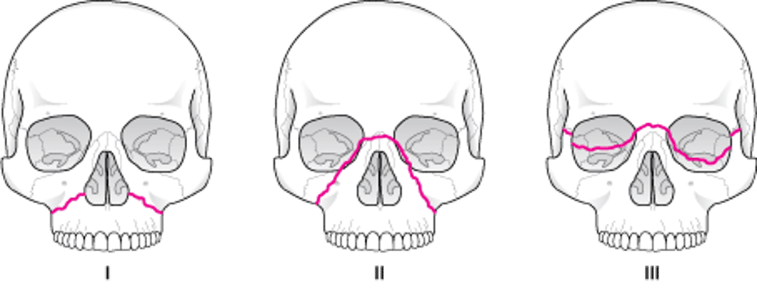 Классификация переломов среднего отдела лица по Ле Фору