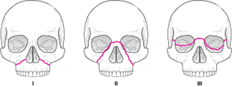 Класифікація переломів середньої зони обличчя за Ле Фором