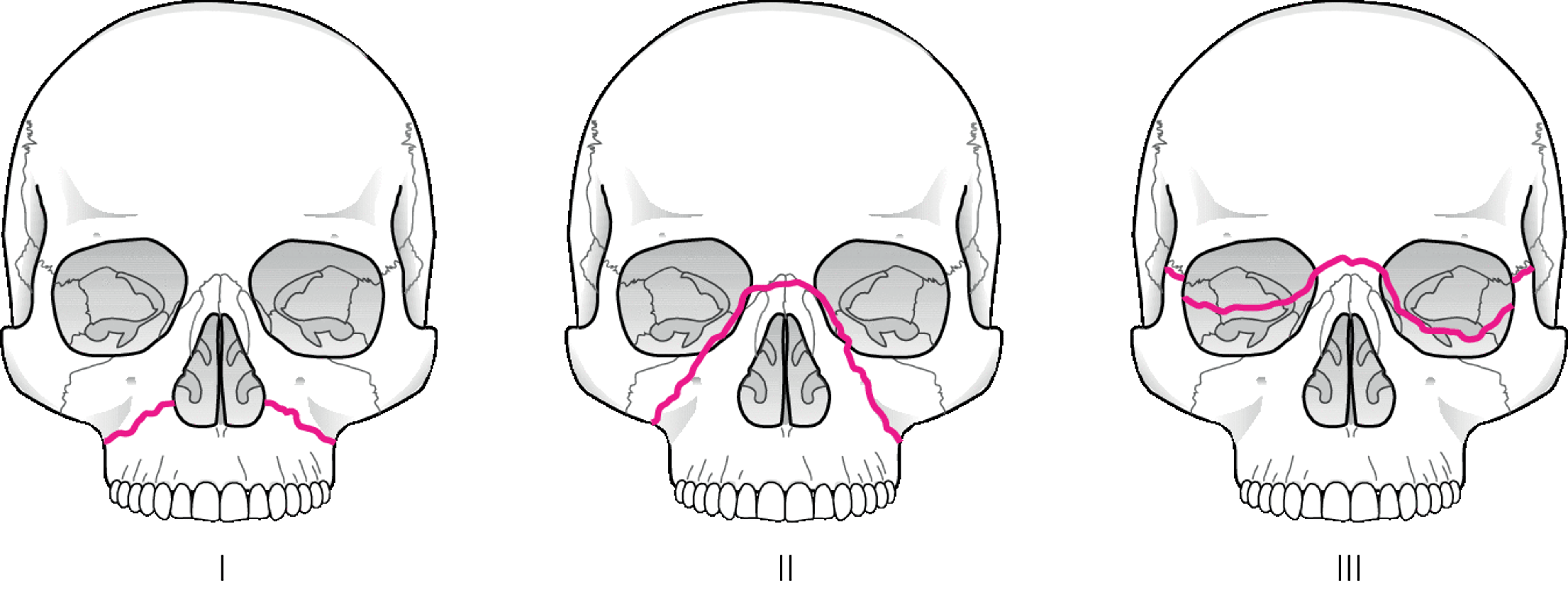 Phân loại gãy xương vùng giữa mặt của Le Fort