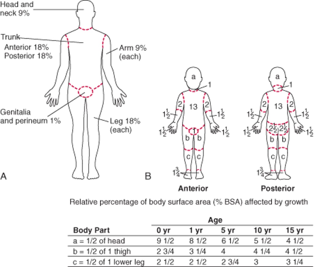(A) Rule of Nines (for Adults) and (B) Lund-Browder Chart (for Children) for Estimating Extent of Burns