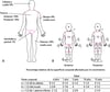 (A) Regla de los nueves (para adultos) y (B) Diagrama de Lund-Browder (para niños) para estimar el alcance de las quemaduras
