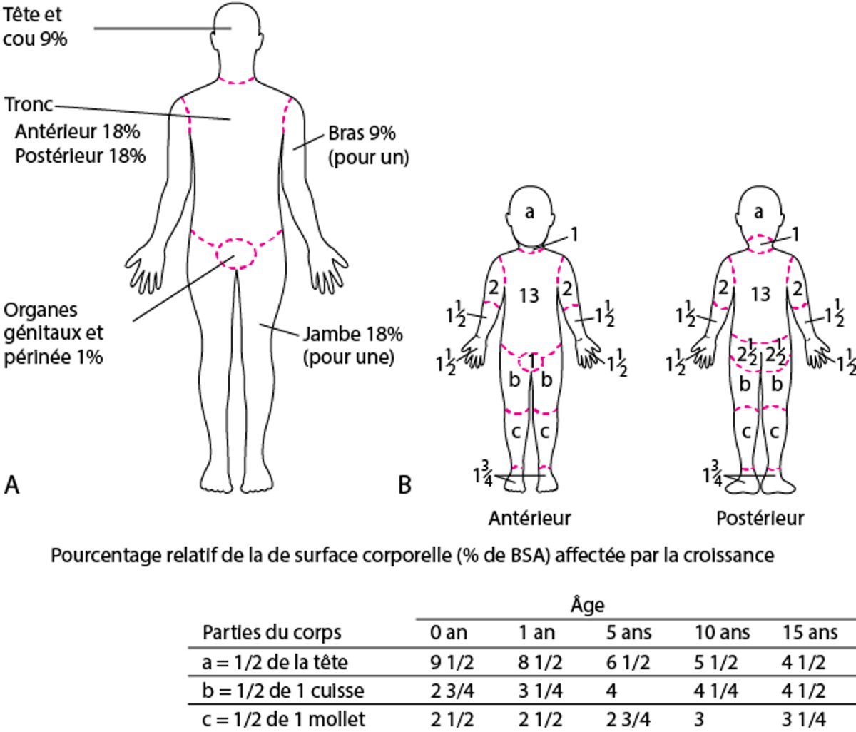 (A) Règle des neufs (pour les adultes) et (B) tableau de Lund-Browder (pour les enfants) pour l'estimation de la surface des brûlures
