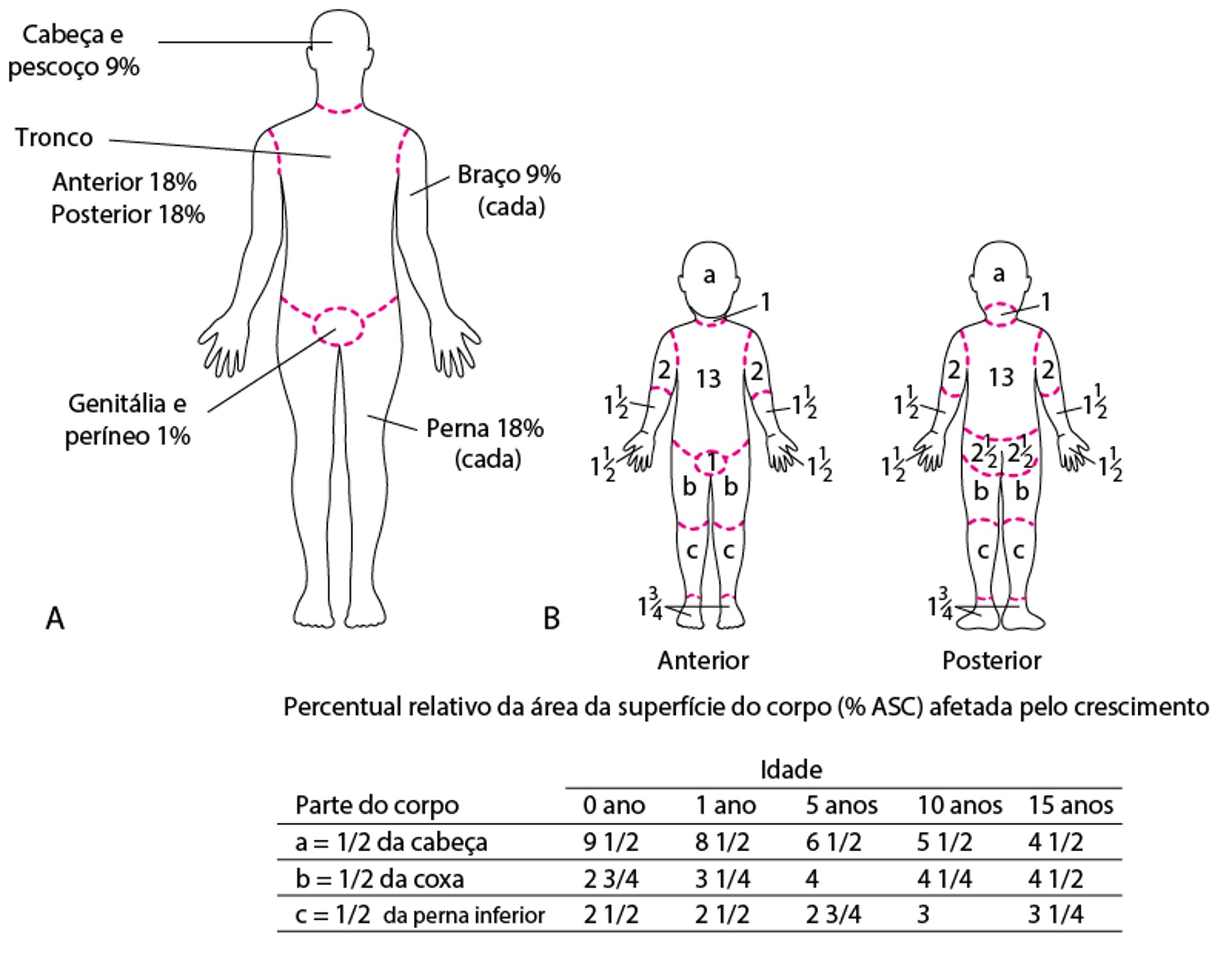(A) Regra dos nove (para adultos) e (B), Tabela de Lund-Browder (para crianças) para estimar a extensão das queimaduras