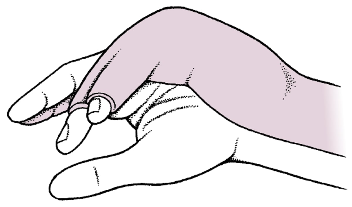 Immobilizzazione con stecca ulnare