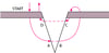 Vertical Mattress Suture
