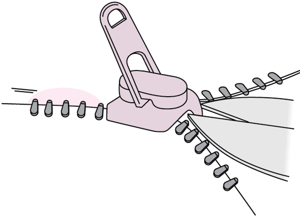 Zipper Removal From Penile Skin