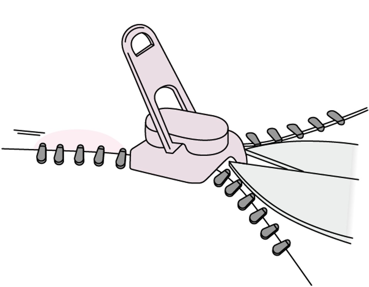 Entfernung eines Reißverschlusses aus der Penishaut