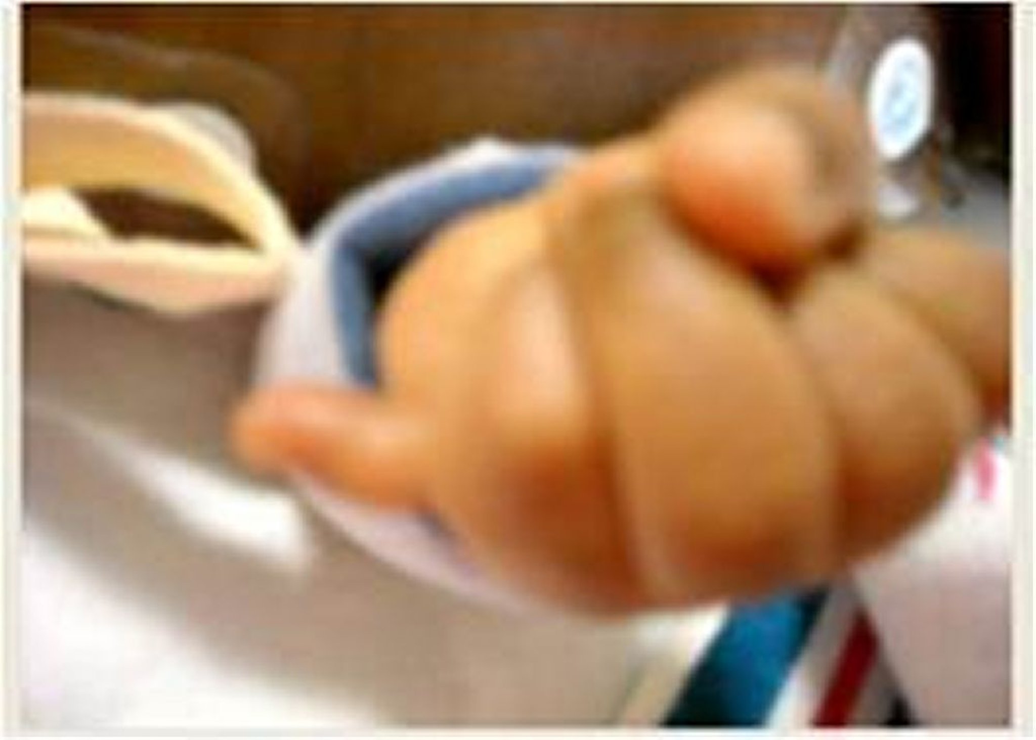 Poing fermé avec polydactylie