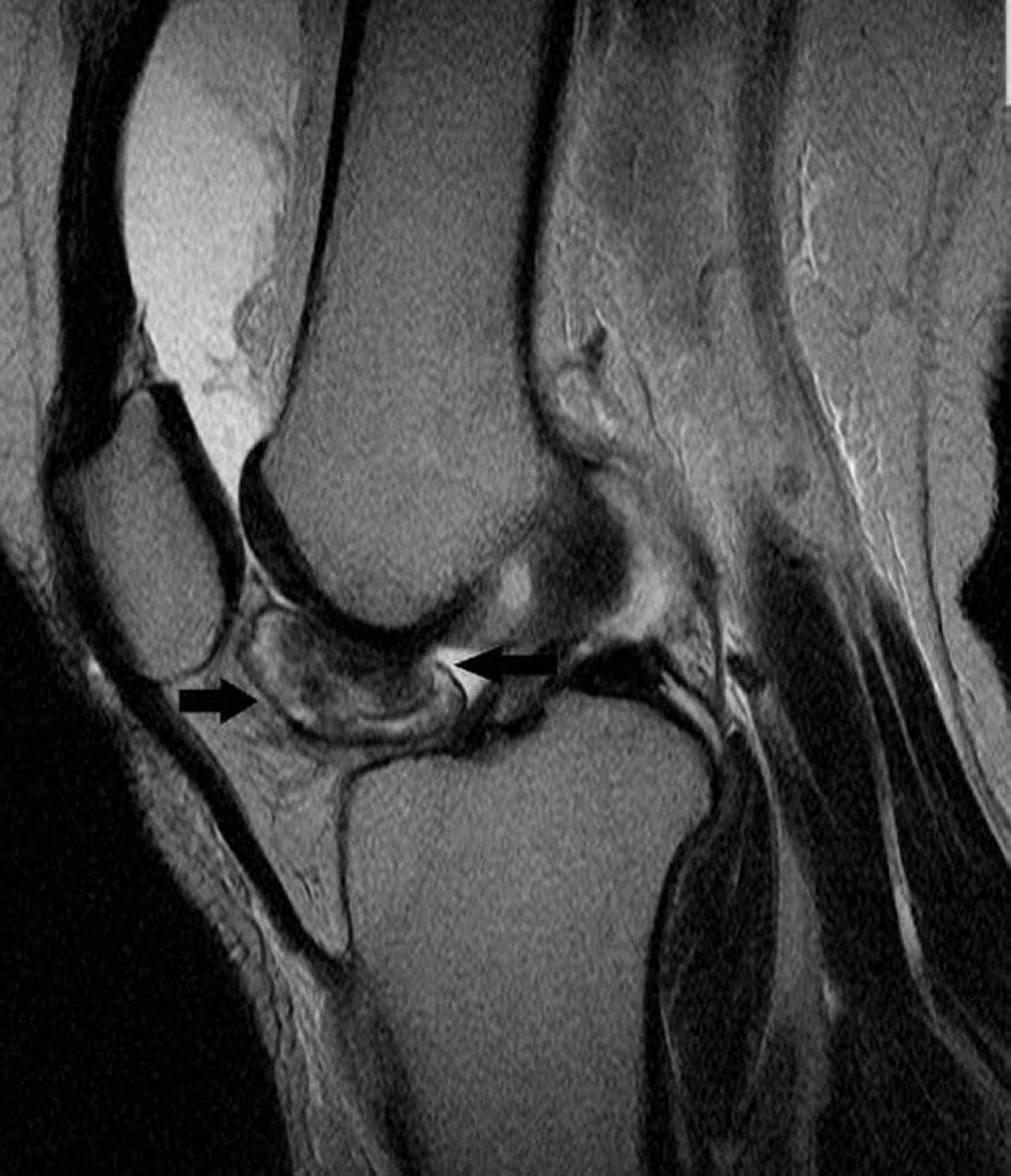 Tenosynovial Giant Cell Tumor