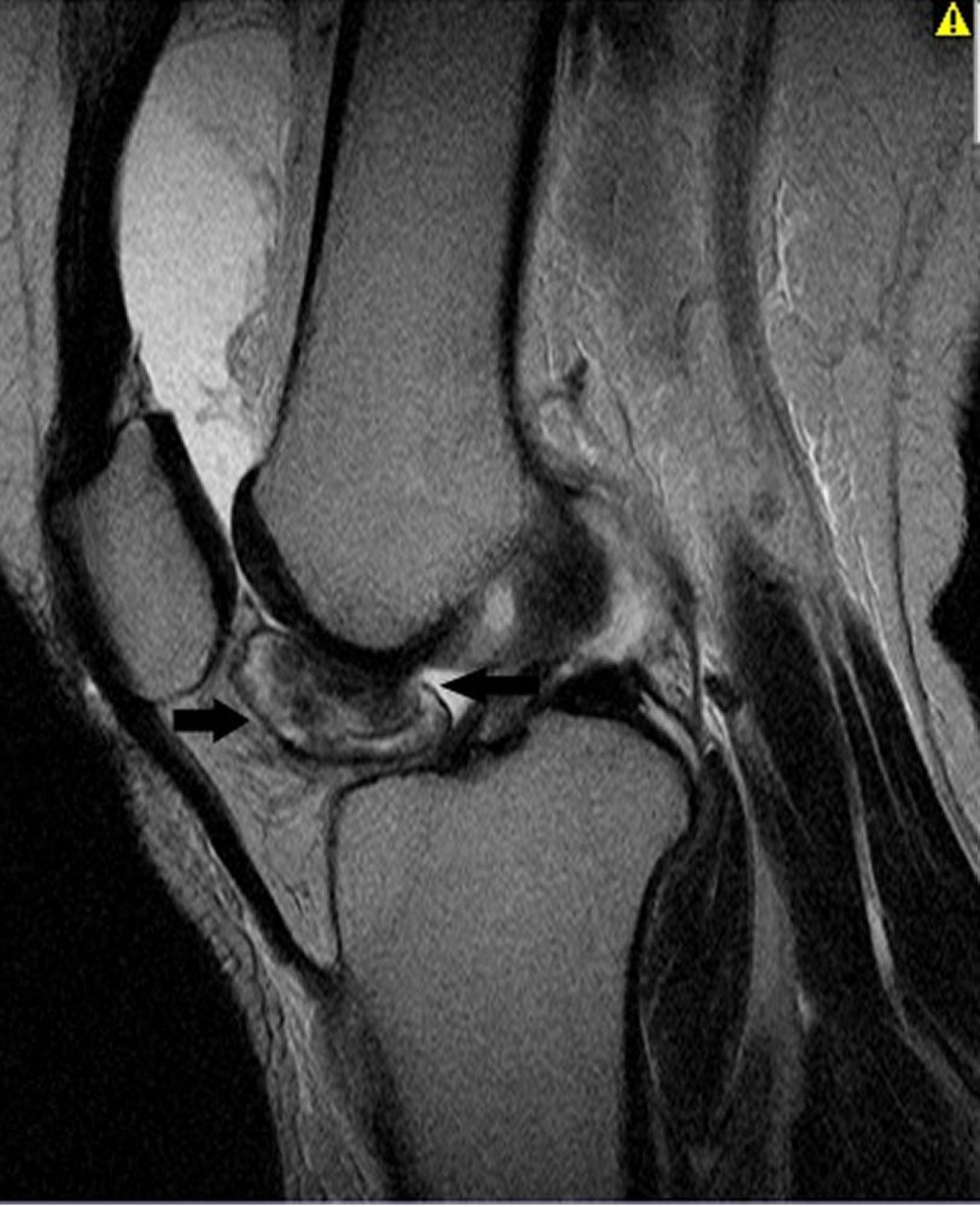 Tumore tenosinoviale a cellule giganti