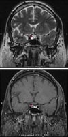 Microadenoma hipofisario
