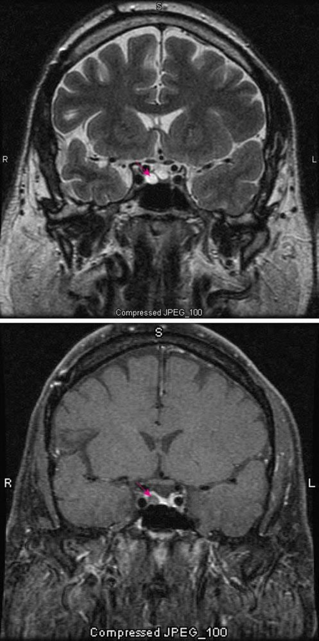 Microadenoma hipofisario