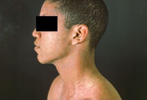 Pityriasis rosé (tête et torse)