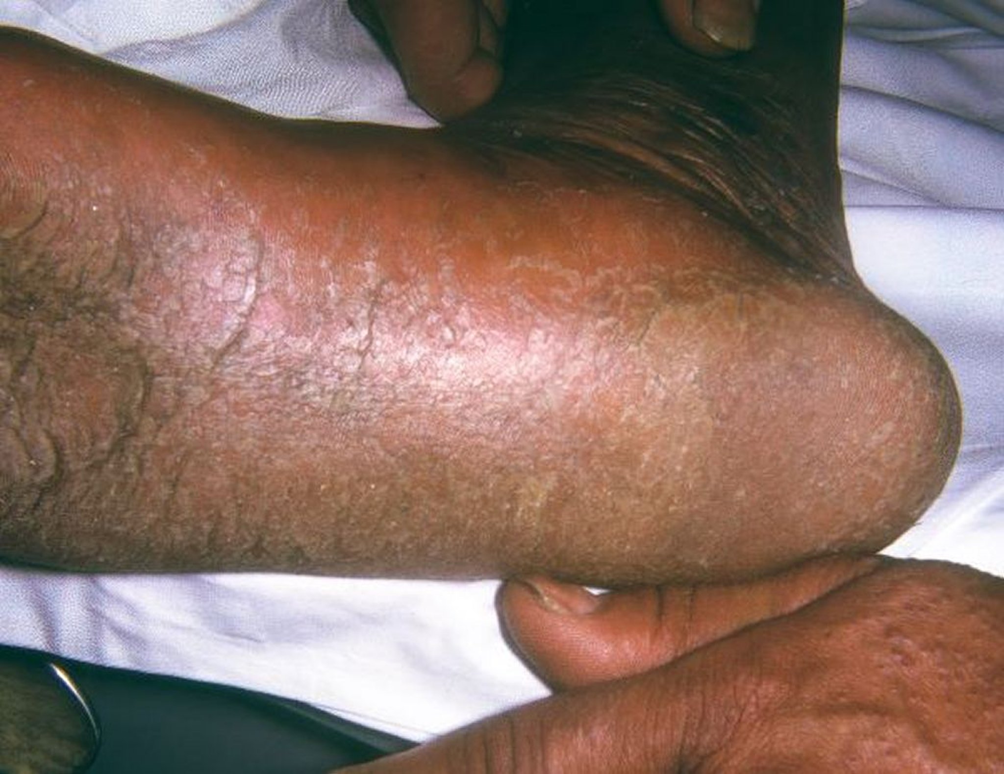 Pitiriasis rubra pilaris (Pie)