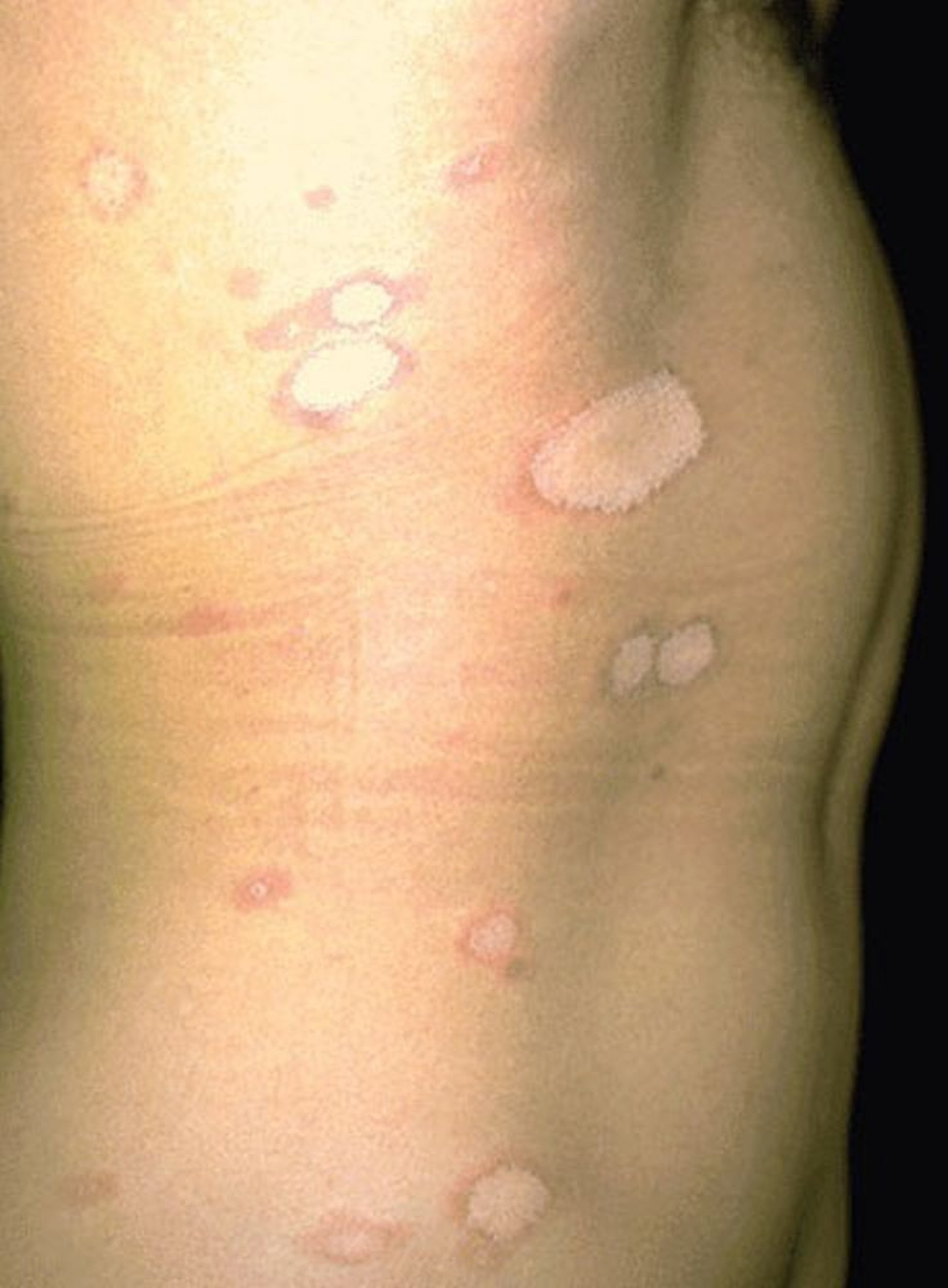 Pityriasis rosé de Gibert