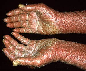Pitiriasis rubra pilaris (palmas hiperqueratósicas)
