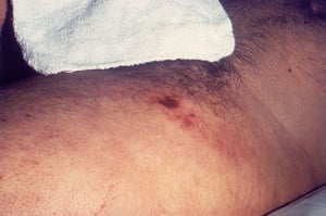 Peste bubbonica (femorale)