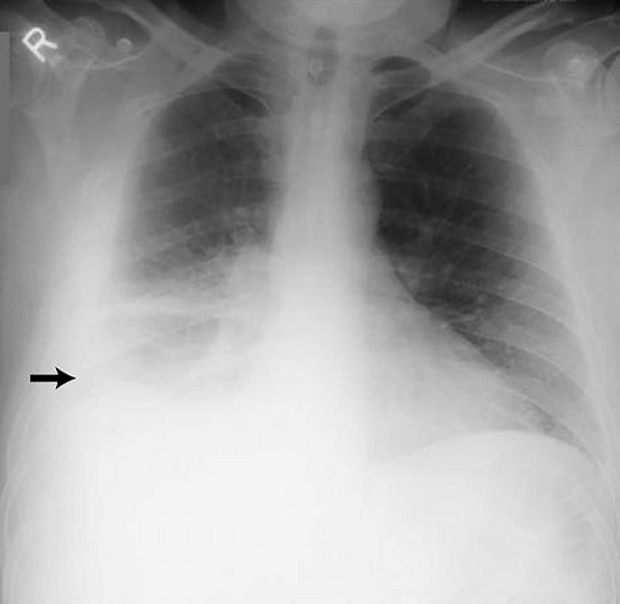 Tràn dịch màng phổi – Nhiều