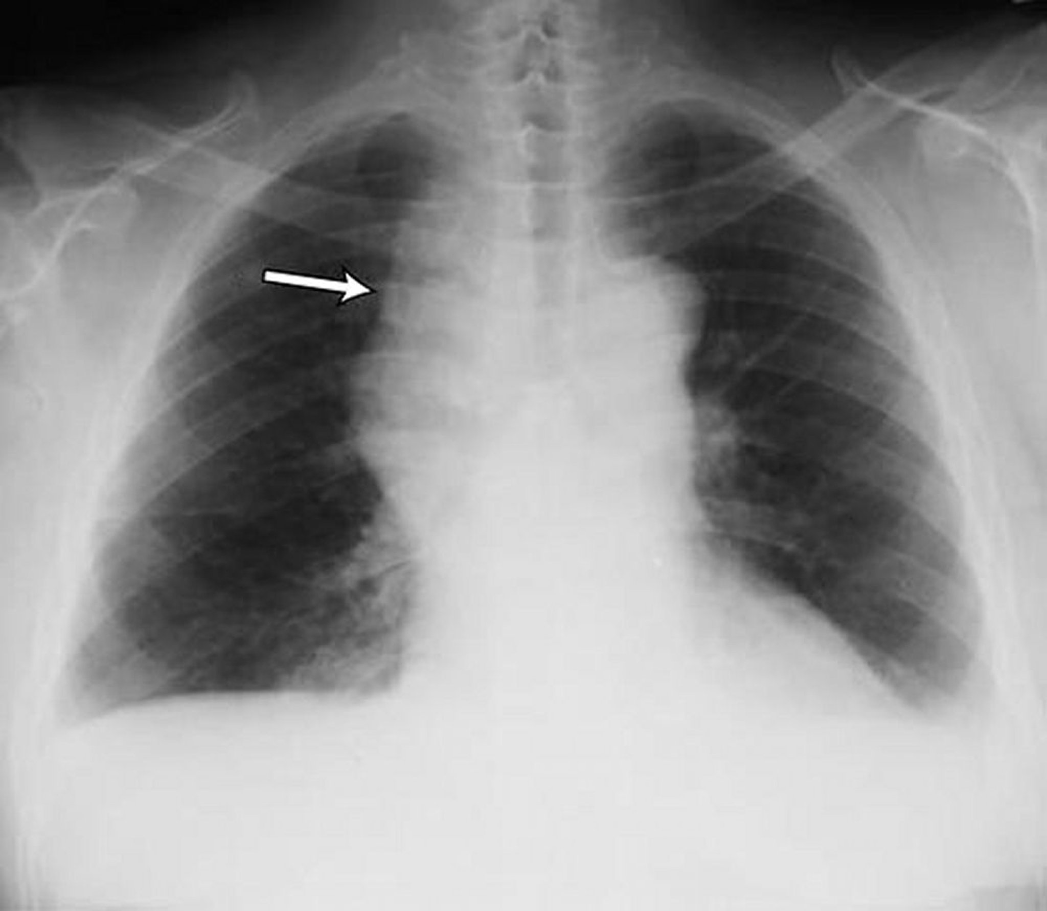 Derrame pleural leve