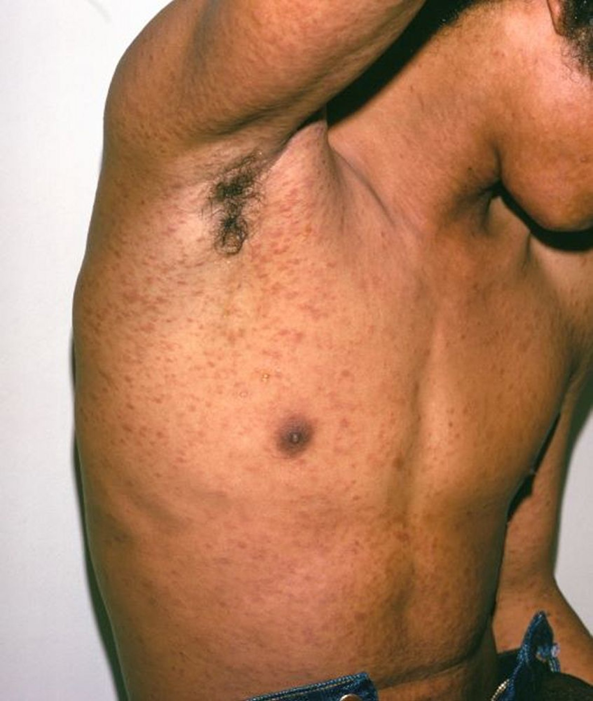 Pityriasis lichénoïde