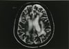 Leucoencefalopatía multifocal progresiva