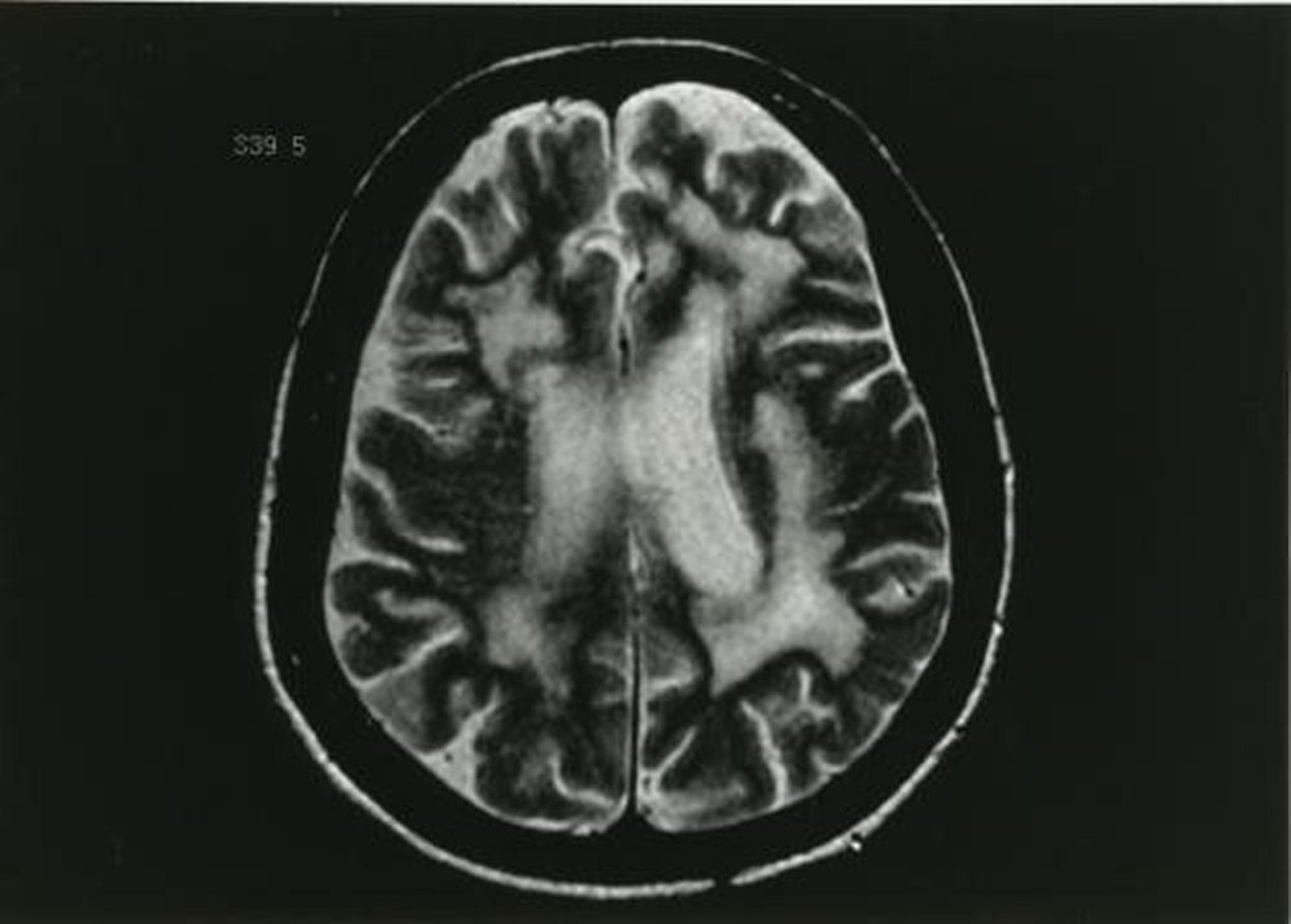 Leucoencefalopatia multifocale progressiva