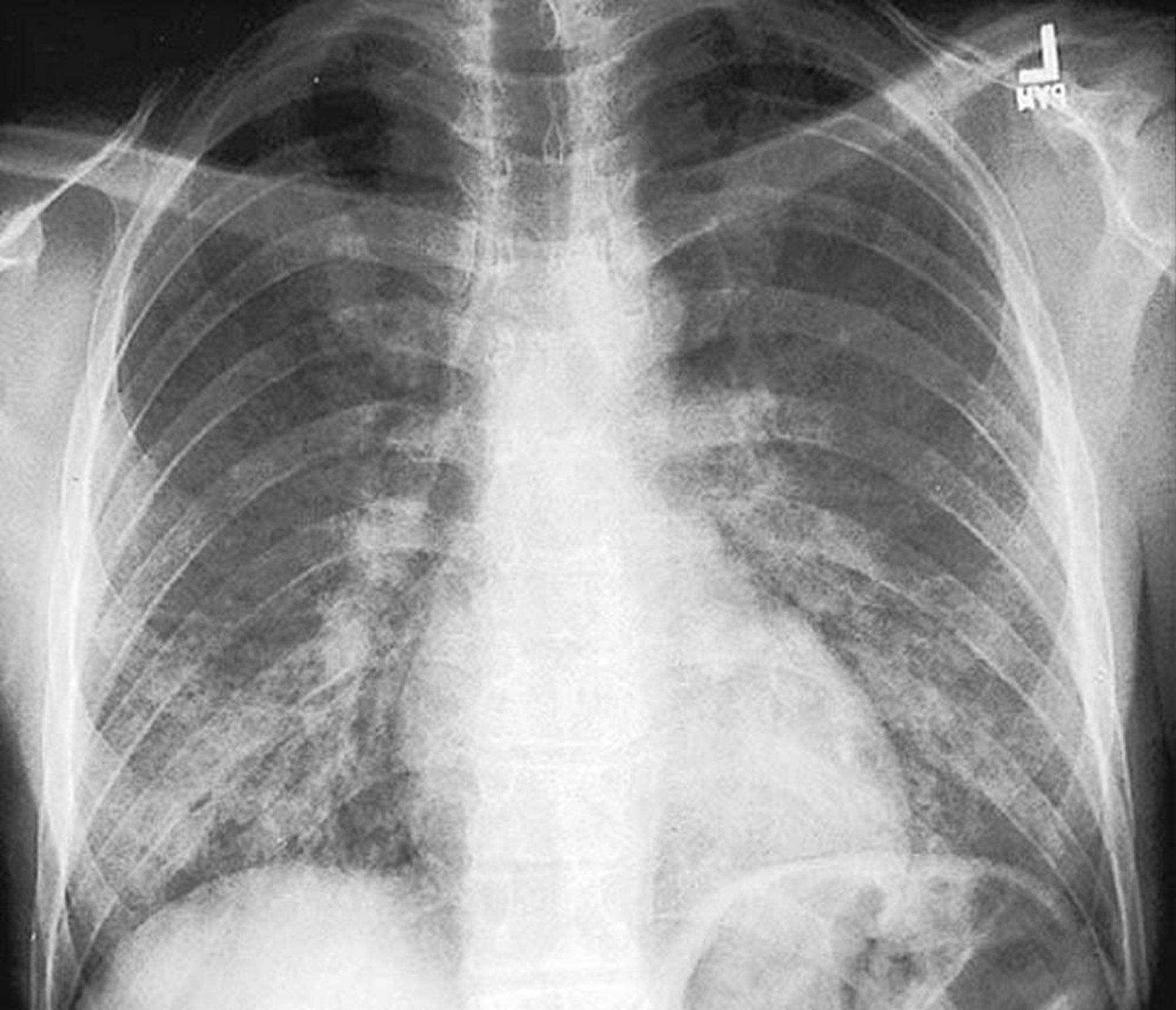 Polmonite da Pneumocystis