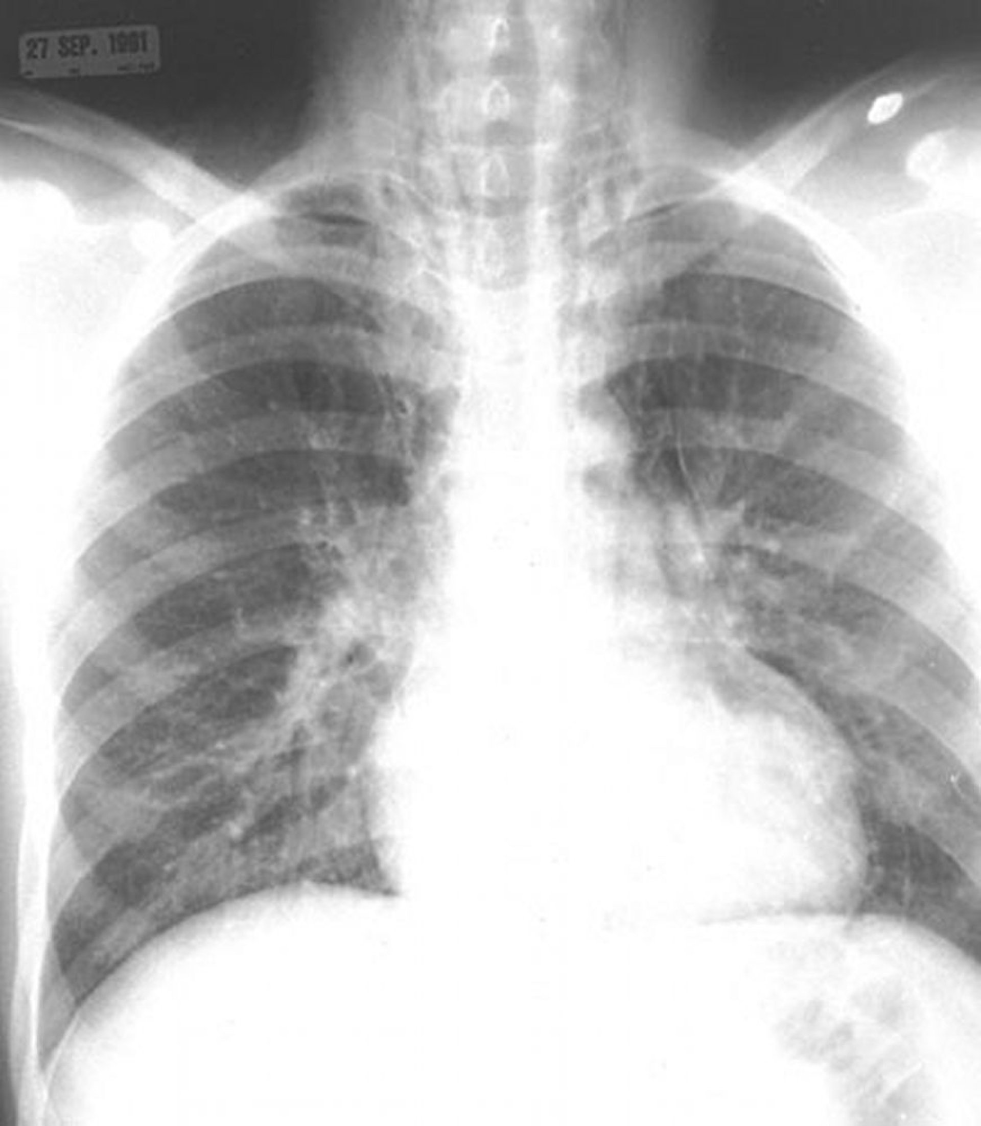 Pneumomediastinum