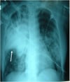 Severe Pneumonia