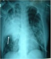 Pneumonia grave