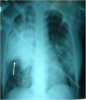 Pneumonia grave
