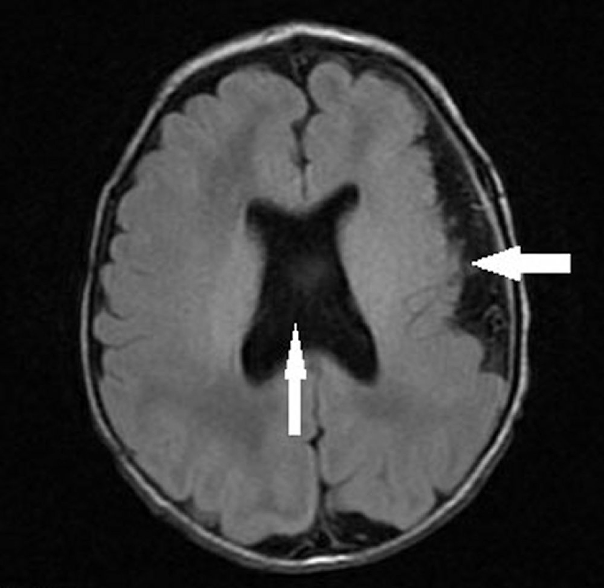 Polymicrogyria with Septo-Optic Dysplasia