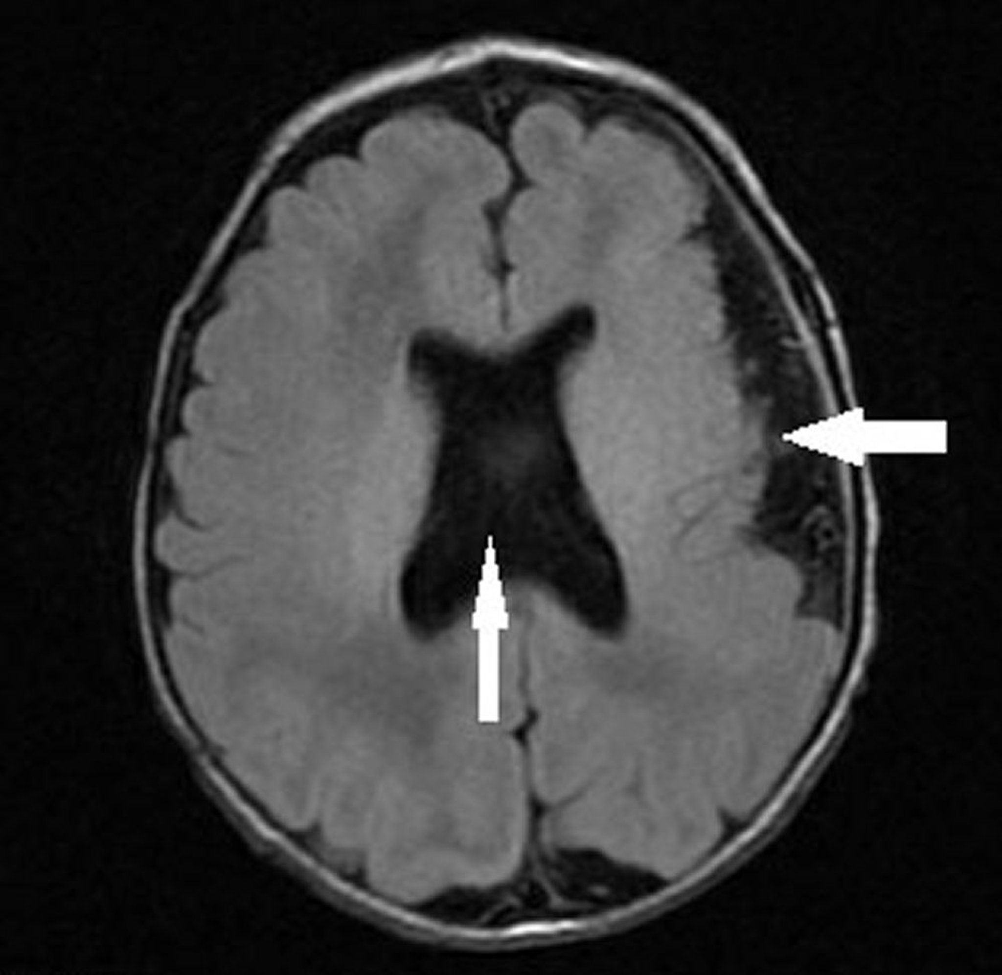 Polymicrogyria với loạn sản vách liên