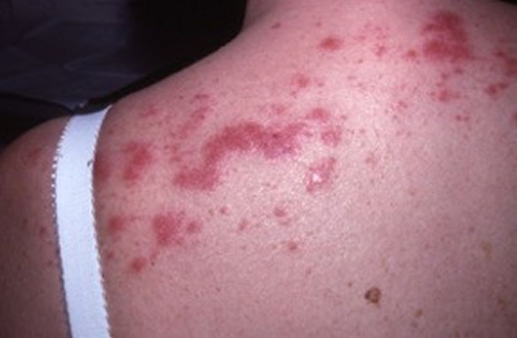 Polymorphous Light Eruption