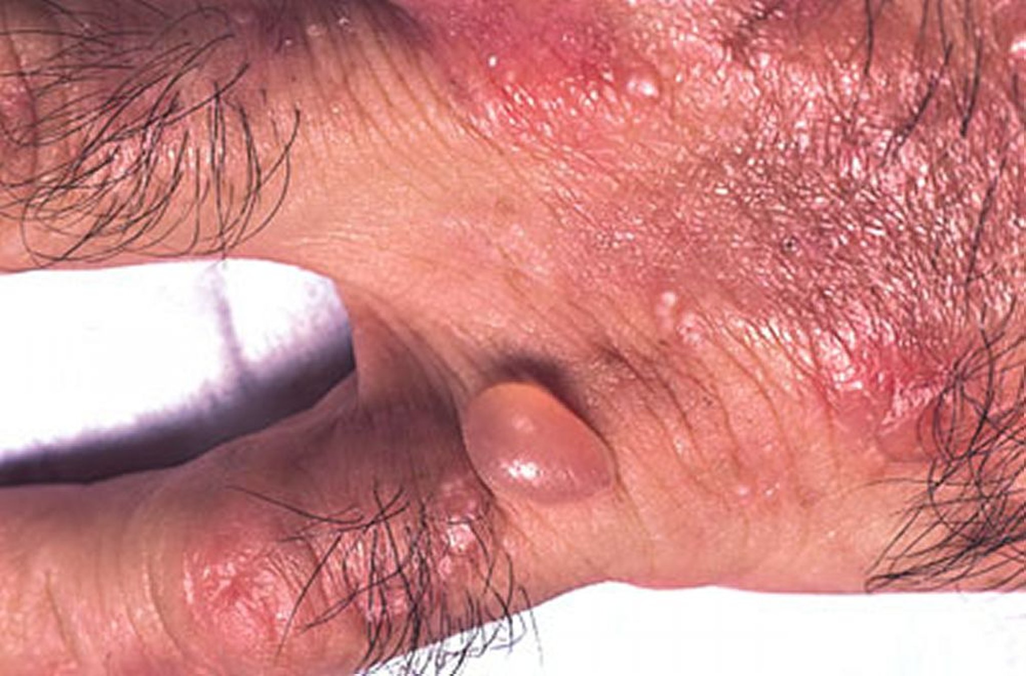 Porphyria cutanea tarda