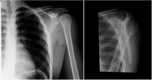 Deslocamento posterior do ombro: incidências em Y e anteroposterior