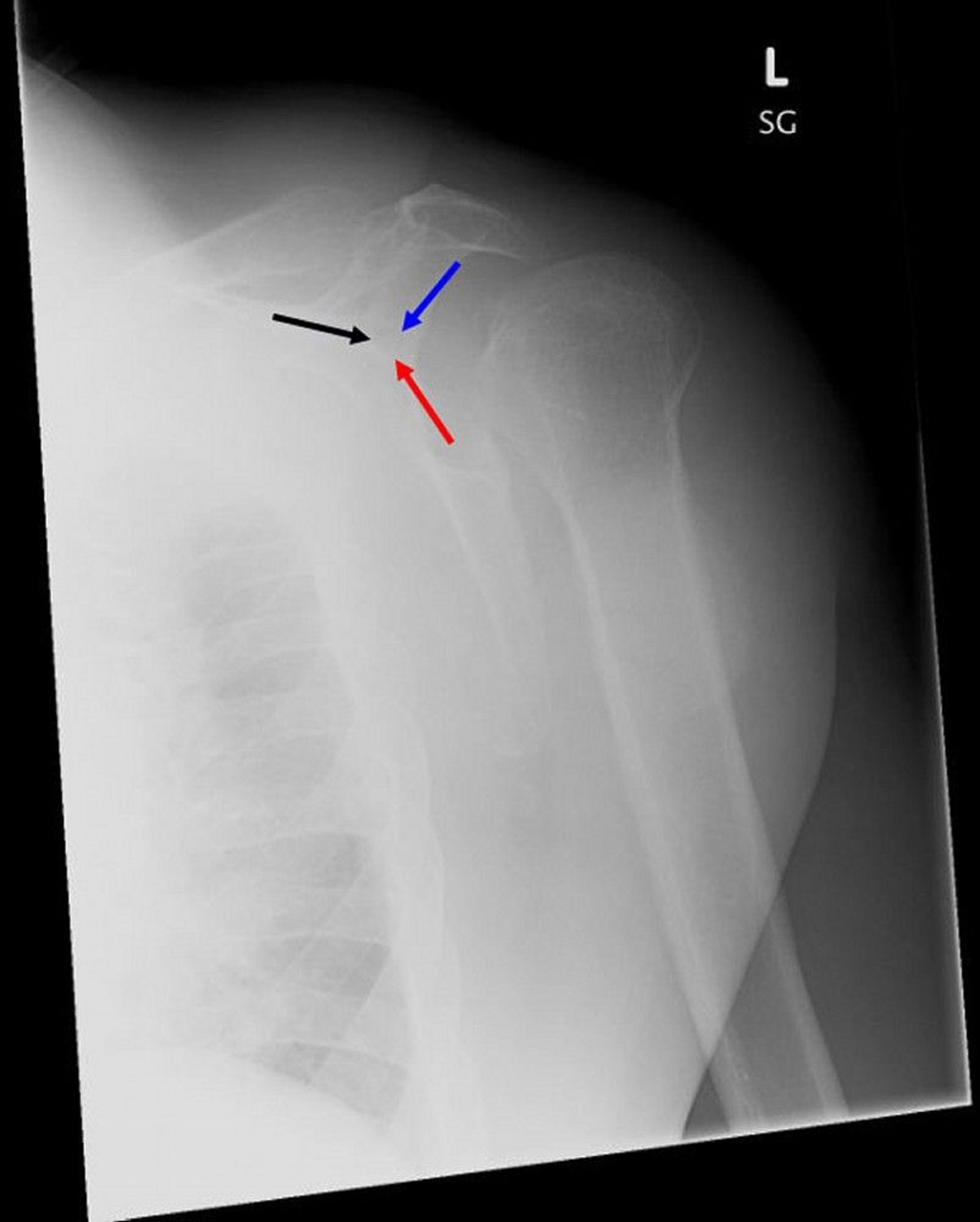 Posterior Shoulder Dislocation: Y View