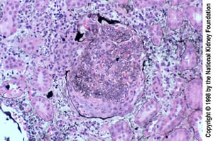 Glomerulonefrite pós-infecciosa (crescentes epiteliais)