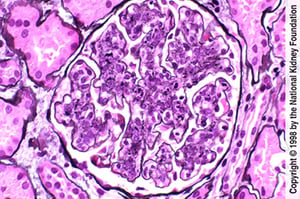 Glomérulonéphrite post-infectieuse (hypercellularité avec infiltration neutrophile)