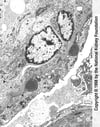 Glomérulonéphrite post-infectieuse (dépôts de complexes immuns)