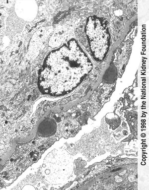 Glomérulonéphrite post-infectieuse (dépôts de complexes immuns)