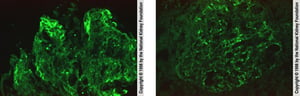 Glomerulonefrite pós-infecciosa (coloração imunofluorescente)